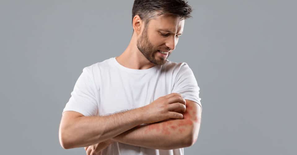 Man Scratching Arm Due to Hives or Urticaria