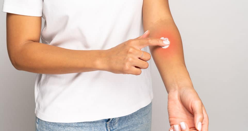 Man applying over-the-counter hydrocortisone cream on a mosquito bite