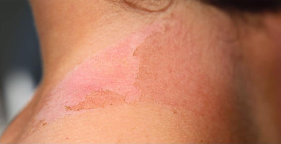 Person with a light sun burn and peeling skin on shoulder